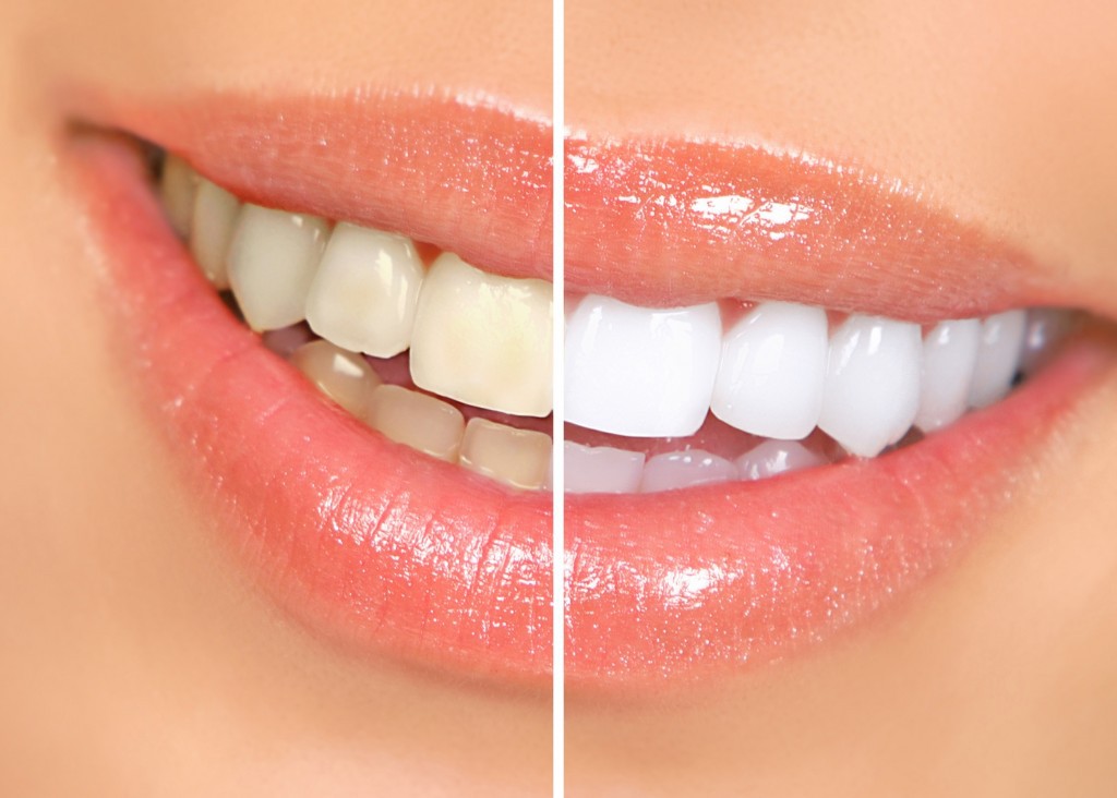Smile-white-teeth-1024x732